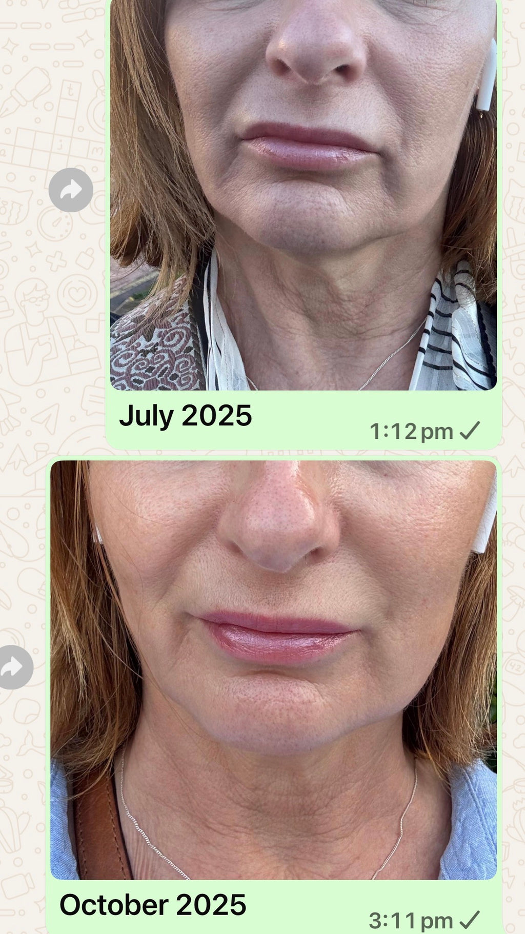 Picture of before and after pic using ems anti-aging device for saggy sking