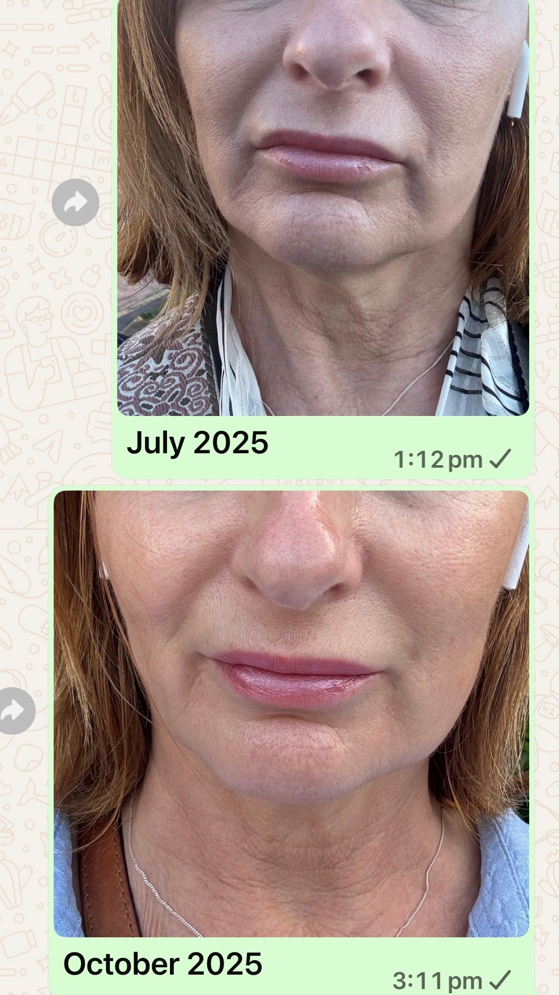 Picture of before and after pic using ems anti-aging device for saggy sking